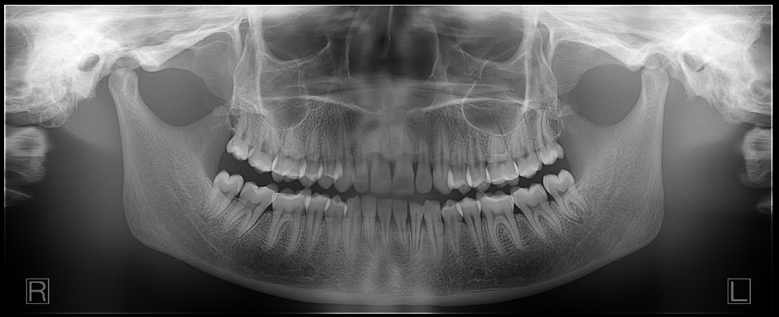 digital dental panoramic x-ray machine